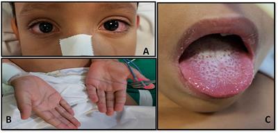Case Report: MIS-C Temporarily Associated With COVID-19 Complicated by Reye's Syndrome